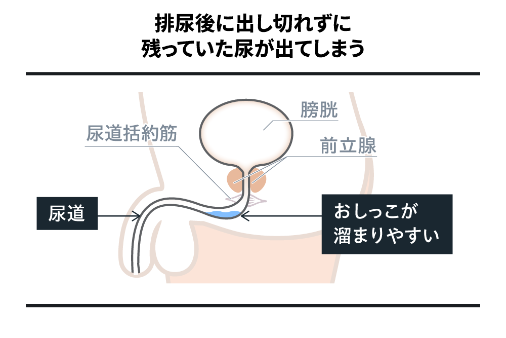 排尿後に出し切れずに残っていた尿が出てしまう