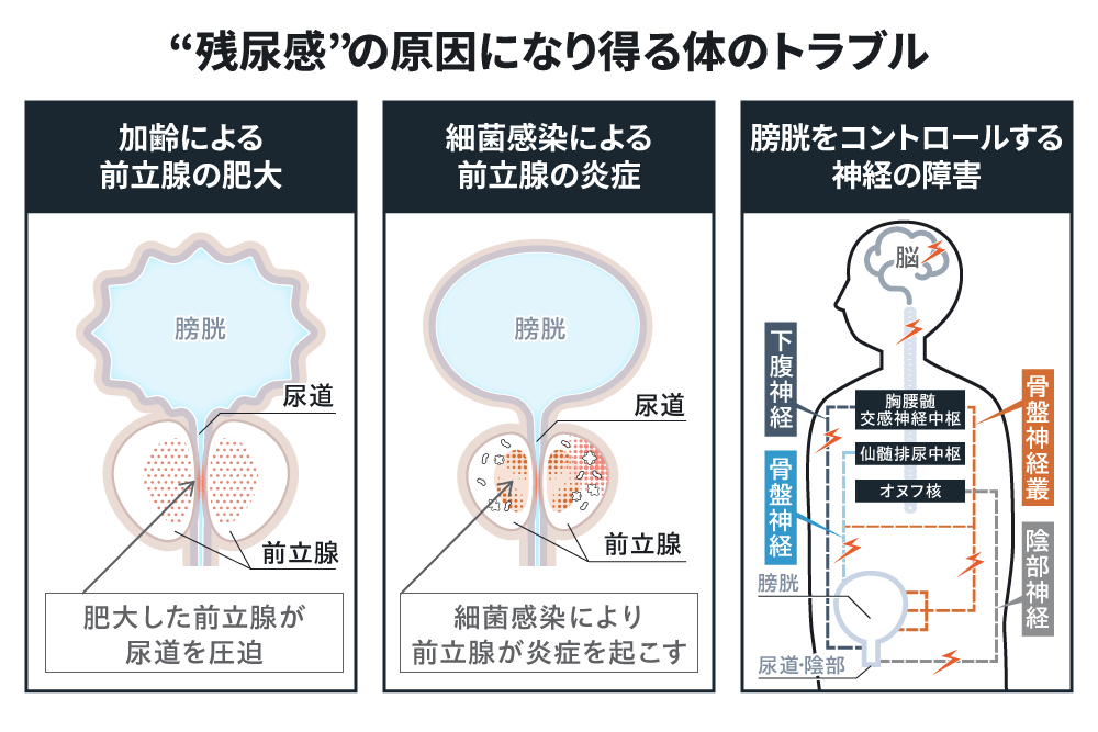 &ldquo;残尿感&rdquo;の原因になり得る体のトラブル 加齢による前立腺の肥大 肥大した前立腺が尿道を圧迫 細菌感染による 前立腺の炎症 細菌感染により前立腺が炎症を起こす 膀胱をコントロールする神経の障害