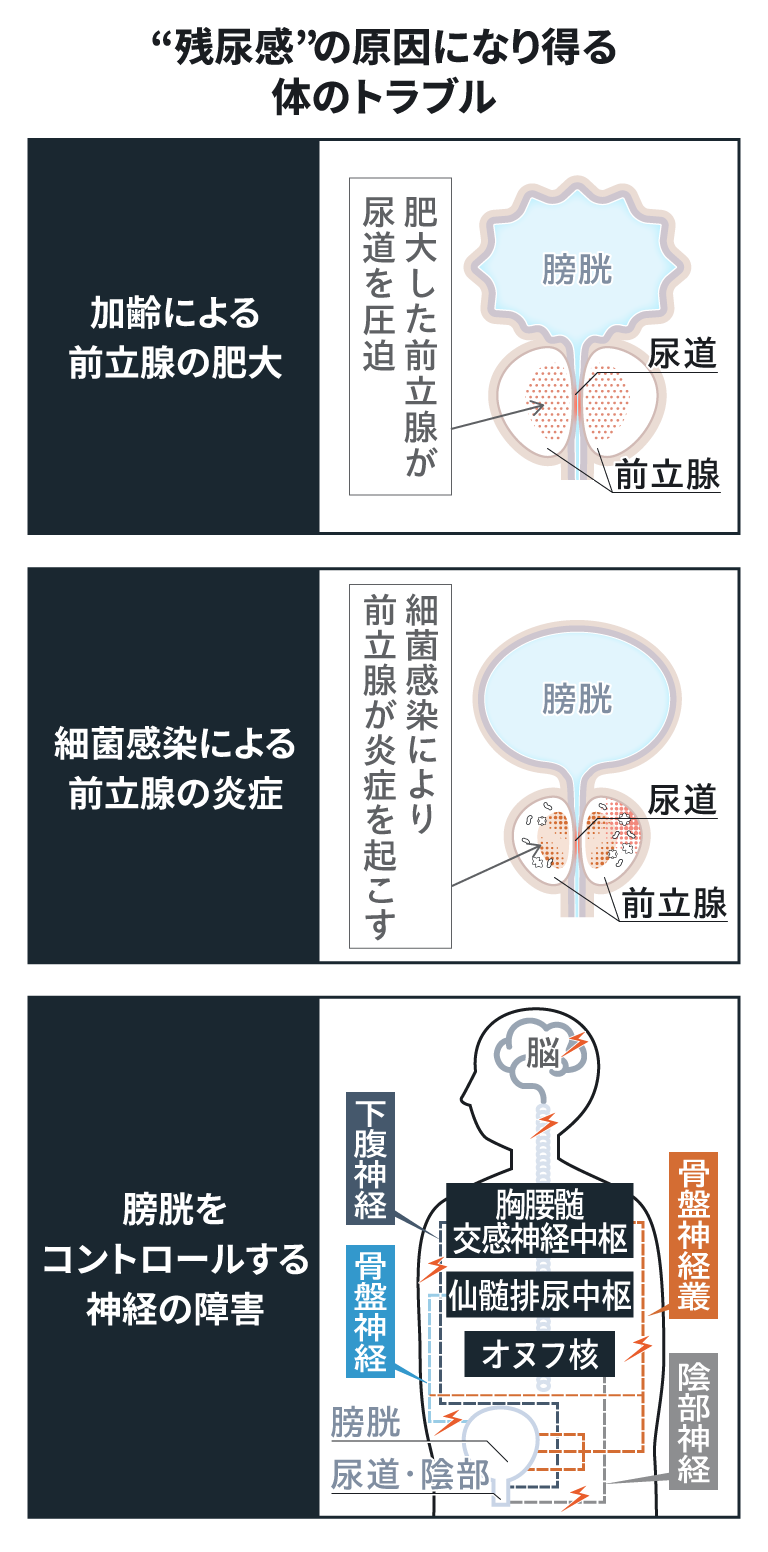&ldquo;残尿感&rdquo;の原因になり得る体のトラブル 加齢による前立腺の肥大 肥大した前立腺が尿道を圧迫 細菌感染による 前立腺の炎症 細菌感染により前立腺が炎症を起こす 膀胱をコントロールする神経の障害
